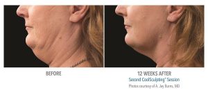 Double-Chin-coolsculpting